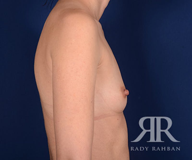 Breast Augmentation Before & After Gallery - Patient 147904 - Image 5