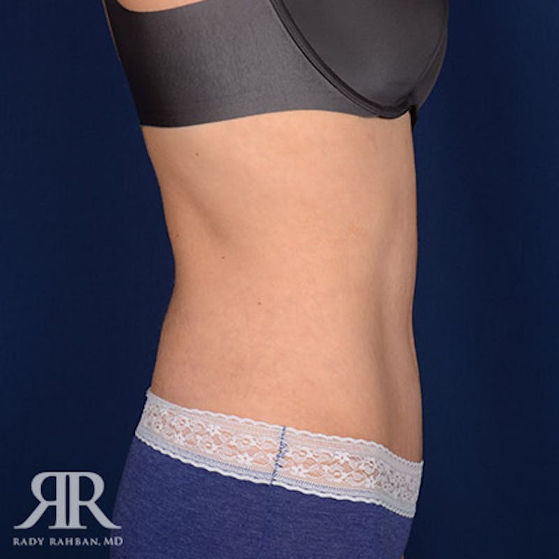 Tummy Tuck Before & After Gallery - Patient 860348 - Image 6