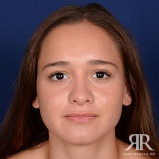 Female Rhinoplasty Before & After Gallery - Patient 195385 - Image 2