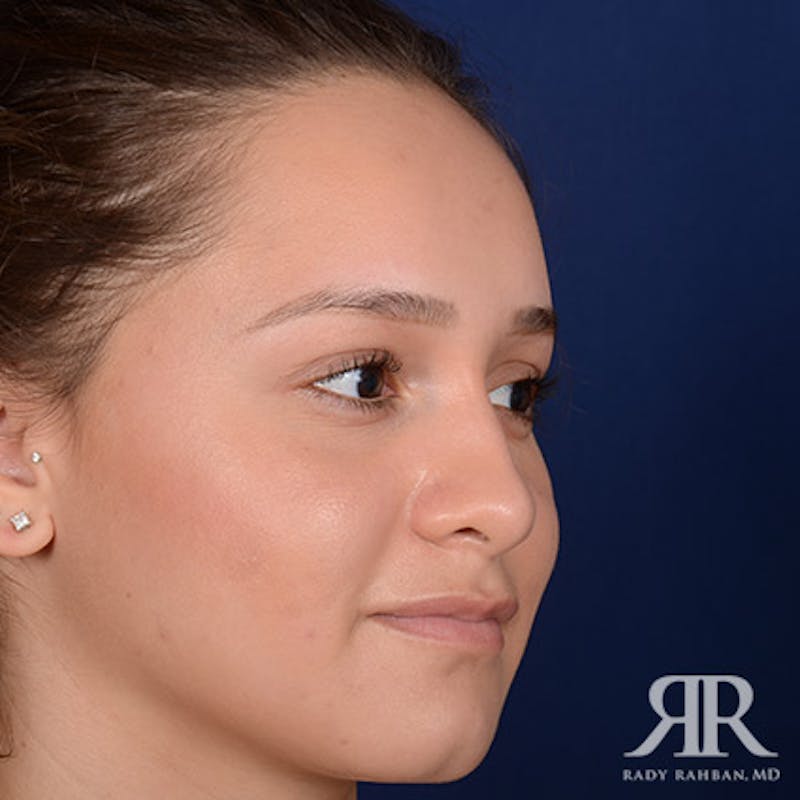Female Rhinoplasty Before & After Gallery - Patient 195385 - Image 3
