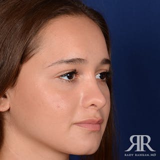 Female Rhinoplasty Before & After Gallery - Patient 195385 - Image 4