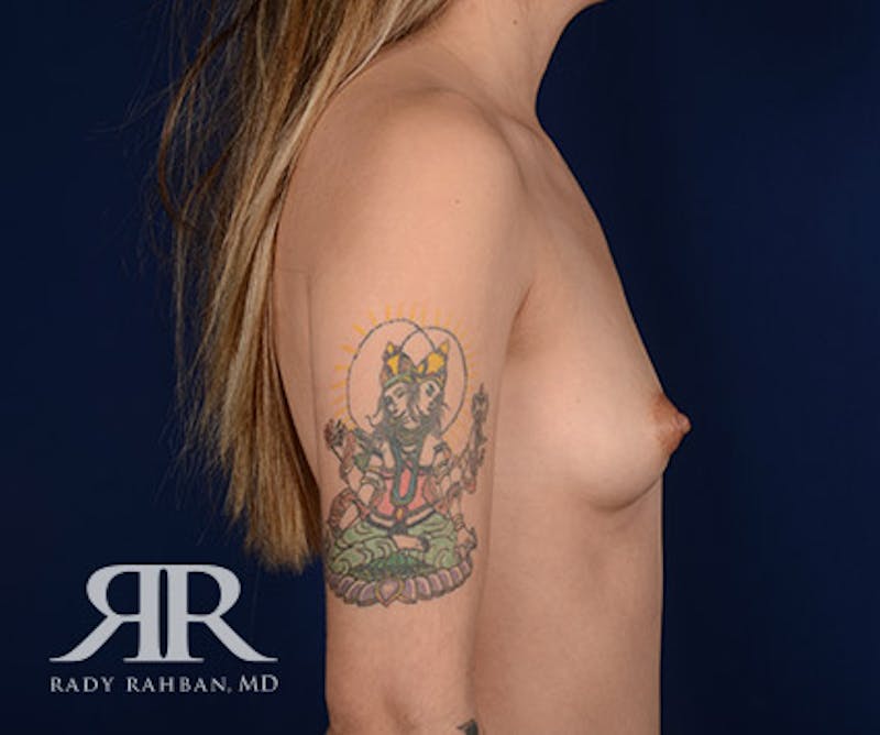 Breast Augmentation Before & After Gallery - Patient 363024 - Image 5