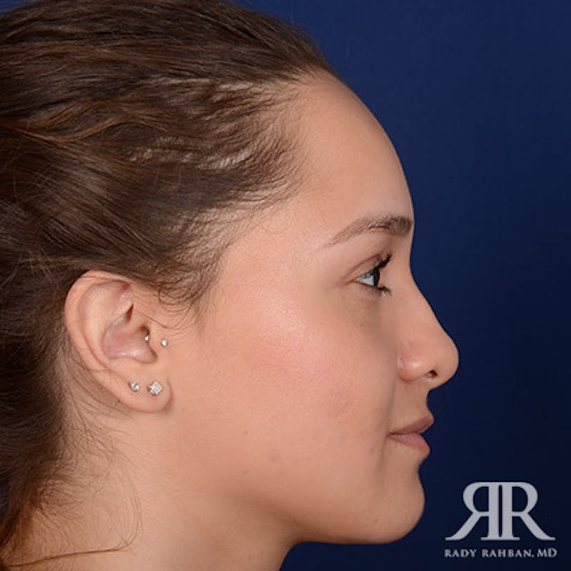 Female Rhinoplasty Before & After Gallery - Patient 195385 - Image 5