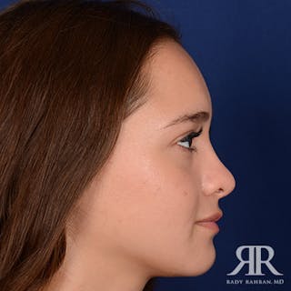Female Rhinoplasty Before & After Gallery - Patient 195385 - Image 6