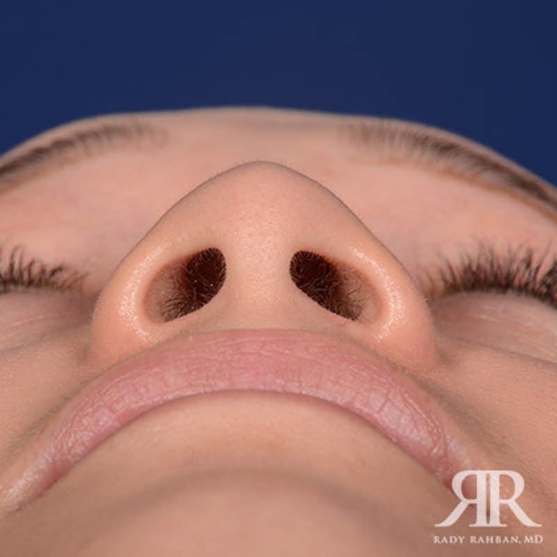 Female Rhinoplasty Before & After Gallery - Patient 195385 - Image 7
