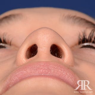Female Rhinoplasty Before & After Gallery - Patient 195385 - Image 8
