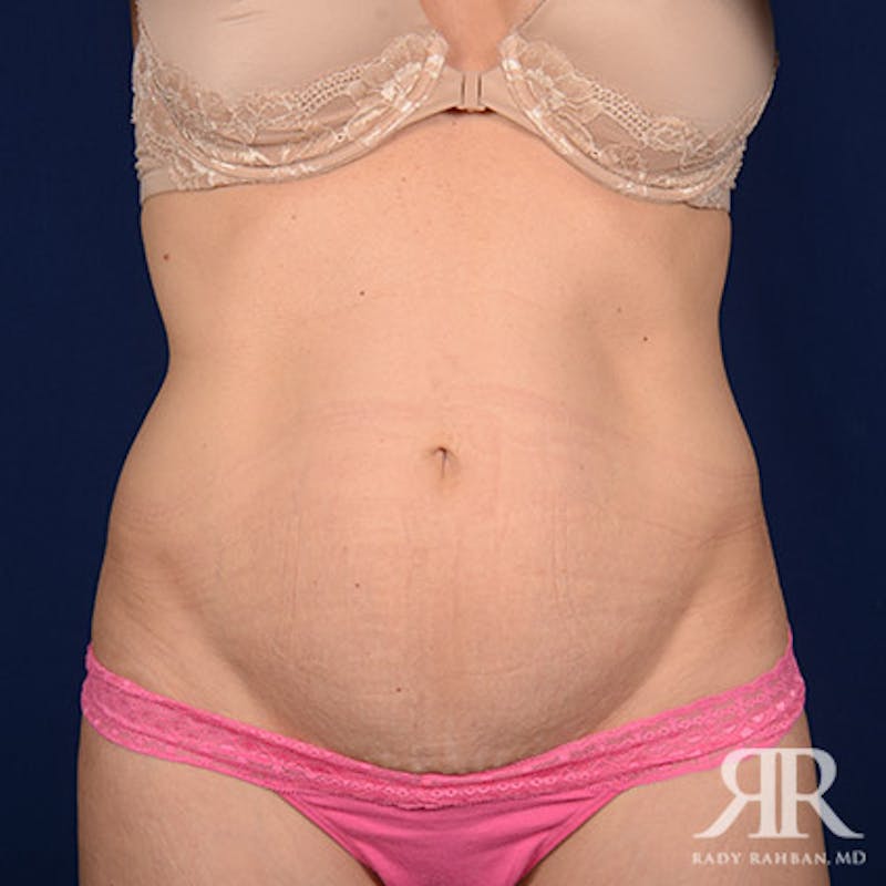 Tummy Tuck Before & After Gallery - Patient 329294 - Image 1
