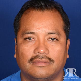 Male Rhinoplasty Before & After Gallery - Patient 667773 - Image 2