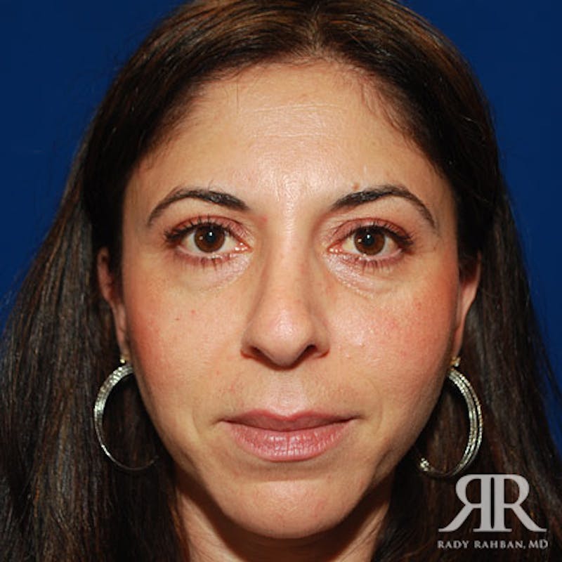 Female Rhinoplasty Before & After Gallery - Patient 280244 - Image 1