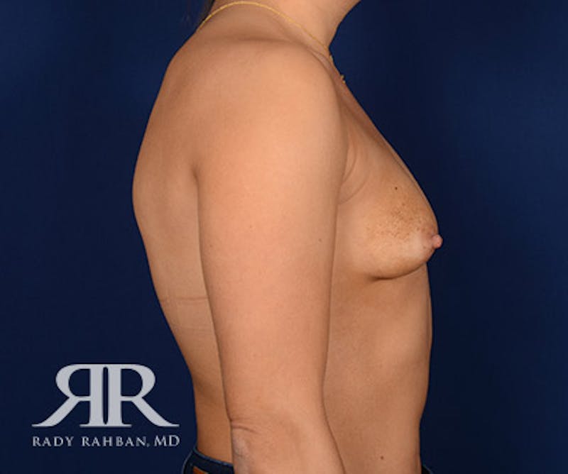 Breast Augmentation Before & After Gallery - Patient 193727 - Image 5