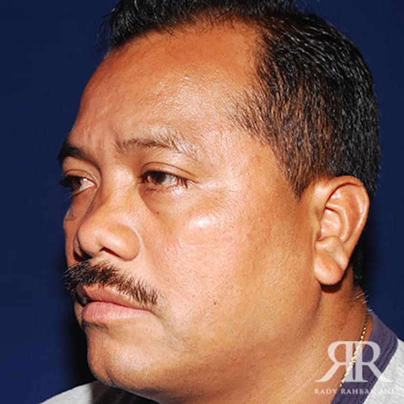 Male Rhinoplasty Before & After Gallery - Patient 667773 - Image 3