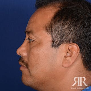 Male Rhinoplasty Before & After Gallery - Patient 667773 - Image 6