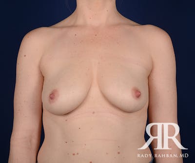 Breast Lift Before & After Gallery - Patient 323220 - Image 1