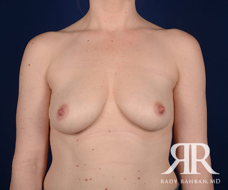 Breast Lift Before & After Gallery - Patient 323220 - Image 1