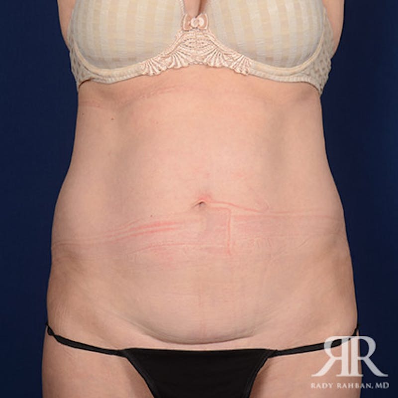 Tummy Tuck Before & After Gallery - Patient 270922 - Image 1
