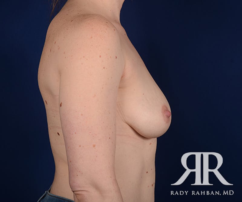 Breast Lift Before & After Gallery - Patient 323220 - Image 5