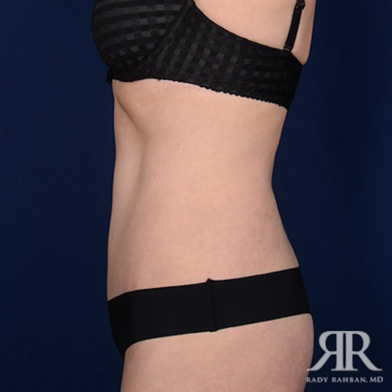 Tummy Tuck Before & After Gallery - Patient 270922 - Image 6