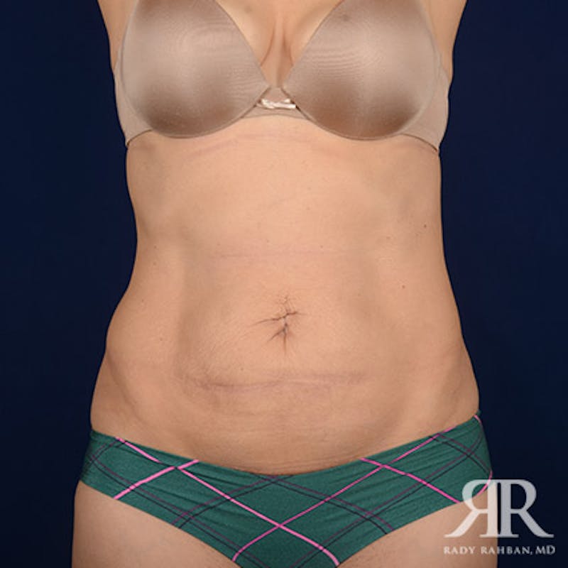 Tummy Tuck Before & After Gallery - Patient 111237 - Image 1