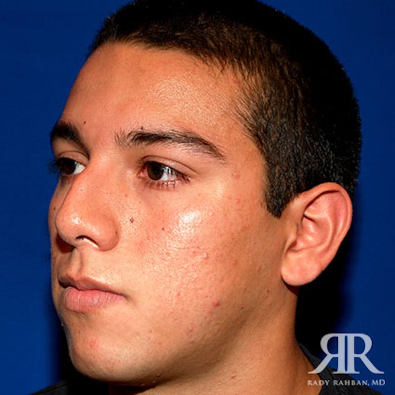 Male Rhinoplasty Before & After Gallery - Patient 140936 - Image 3