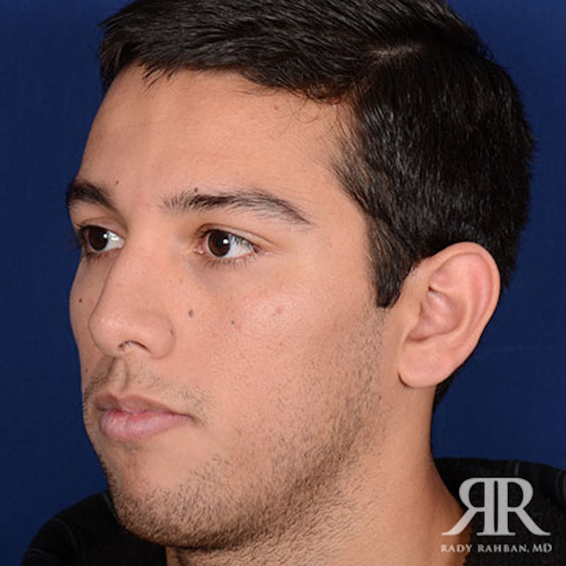 Male Rhinoplasty Before & After Gallery - Patient 140936 - Image 4