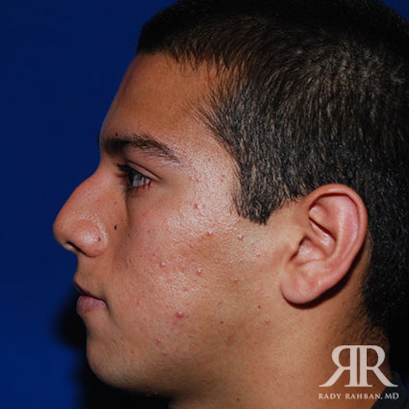 Male Rhinoplasty Before & After Gallery - Patient 140936 - Image 5