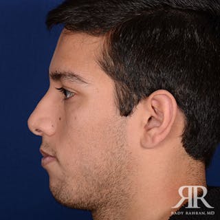 Male Rhinoplasty Before & After Gallery - Patient 140936 - Image 6