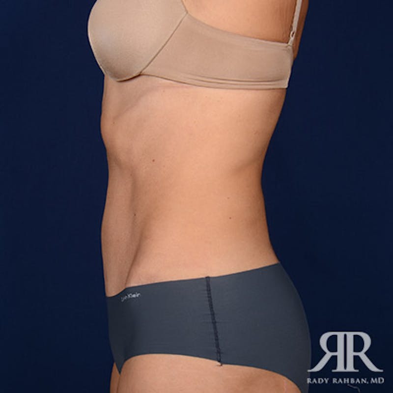 Tummy Tuck Before & After Gallery - Patient 111237 - Image 6
