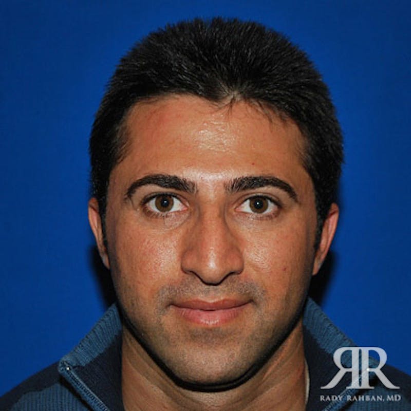 Male Rhinoplasty Before & After Gallery - Patient 123831 - Image 1