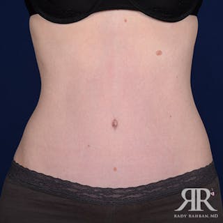 Tummy Tuck Before & After Gallery - Patient 303268 - Image 2