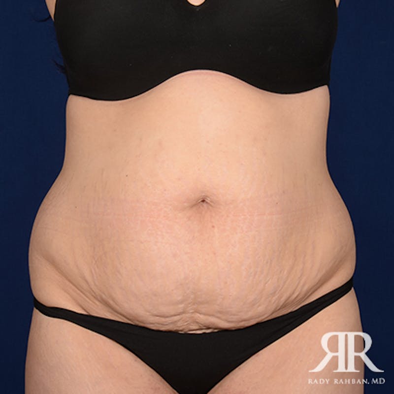 Tummy Tuck Before & After Gallery - Patient 190050 - Image 1