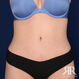 Tummy Tuck Before & After Gallery - Patient 190050 - Image 2
