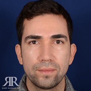 Male Rhinoplasty Before & After Gallery - Patient 333340 - Image 2