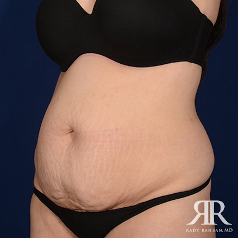 Tummy Tuck Before & After Gallery - Patient 190050 - Image 3