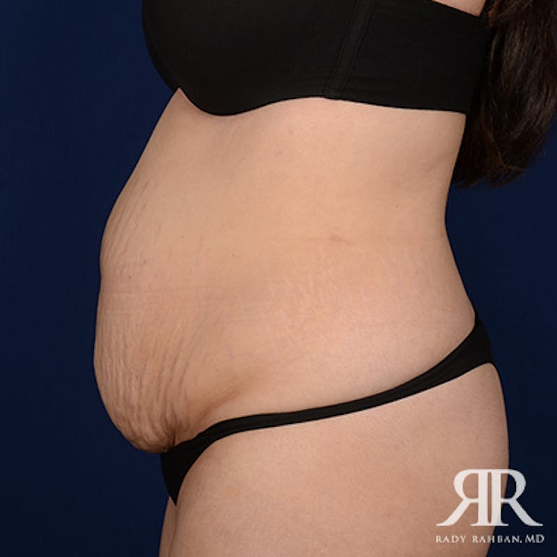Tummy Tuck Before & After Gallery - Patient 190050 - Image 5