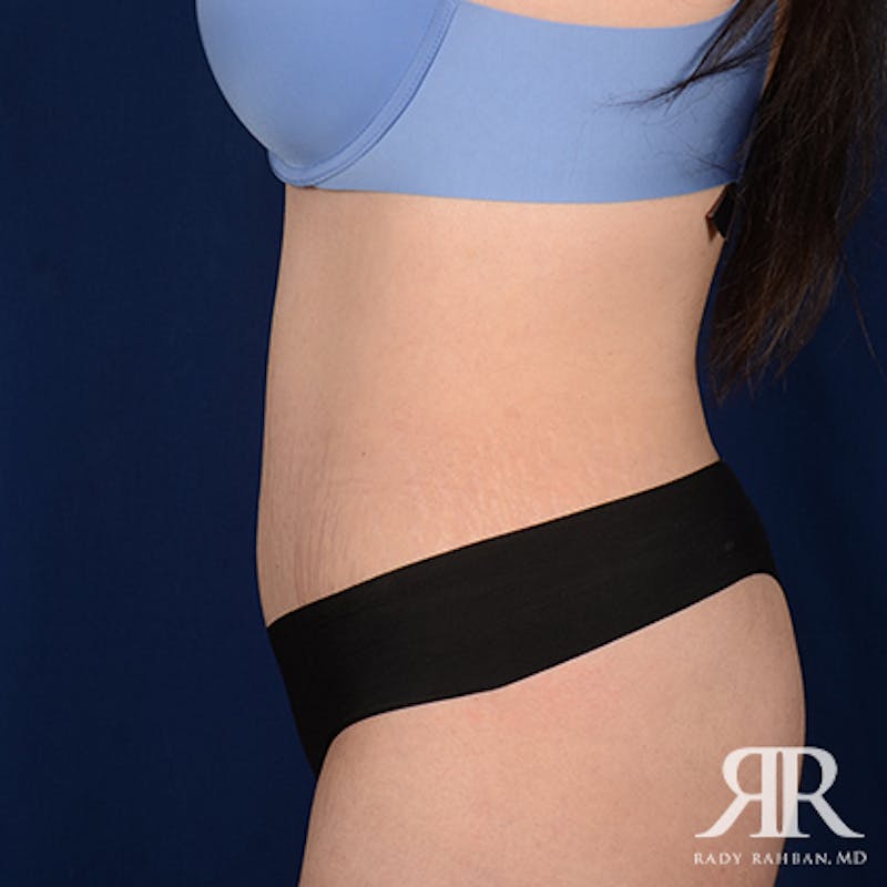Tummy Tuck Before & After Gallery - Patient 190050 - Image 6