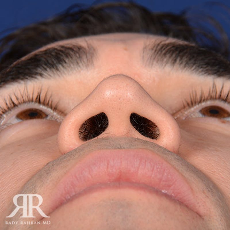 Male Rhinoplasty Before & After Gallery - Patient 333340 - Image 7