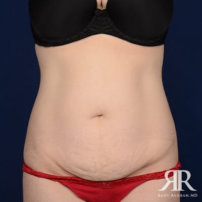 Tummy Tuck Before & After Gallery - Patient 218609 - Image 1