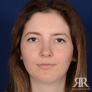 Female Rhinoplasty Before & After Gallery - Patient 379137 - Image 2