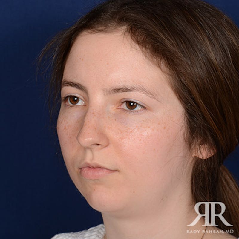 Female Rhinoplasty Before & After Gallery - Patient 379137 - Image 3