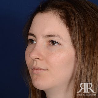 Female Rhinoplasty Before & After Gallery - Patient 379137 - Image 4