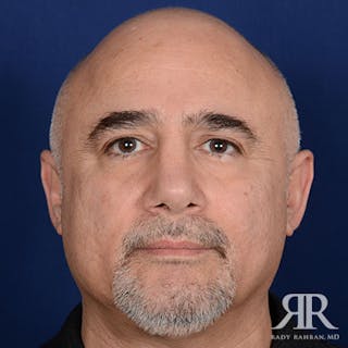 Male Rhinoplasty Before & After Gallery - Patient 223295 - Image 2