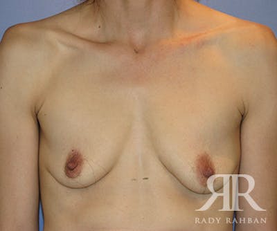 Breast Augmentation Before & After Gallery - Patient 367425 - Image 1