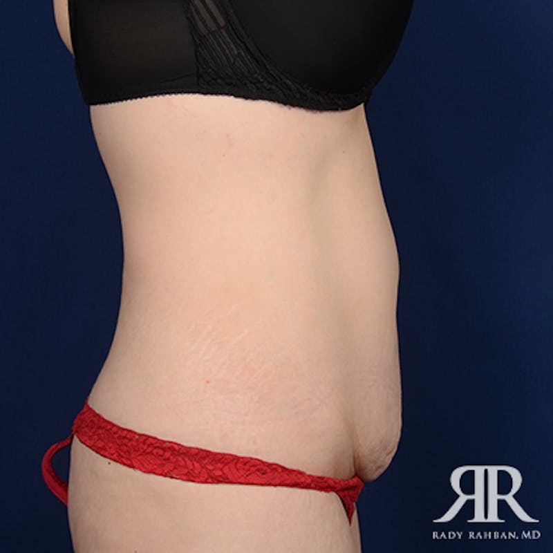 Tummy Tuck Before & After Gallery - Patient 218609 - Image 5