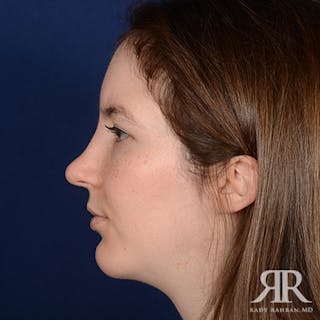 Female Rhinoplasty Before & After Gallery - Patient 379137 - Image 6