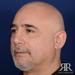 Male Rhinoplasty Before & After Gallery - Patient 223295 - Image 4
