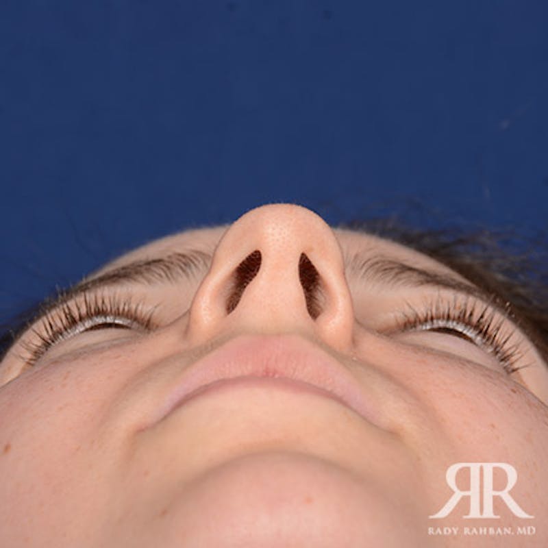 Female Rhinoplasty Before & After Gallery - Patient 379137 - Image 7