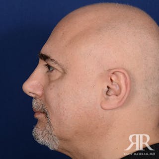 Male Rhinoplasty Before & After Gallery - Patient 223295 - Image 6