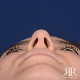 Female Rhinoplasty Before & After Gallery - Patient 379137 - Image 8