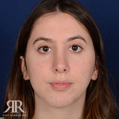 Female Rhinoplasty Before & After Gallery - Patient 116917 - Image 2
