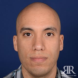 Male Rhinoplasty Before & After Gallery - Patient 281326 - Image 2